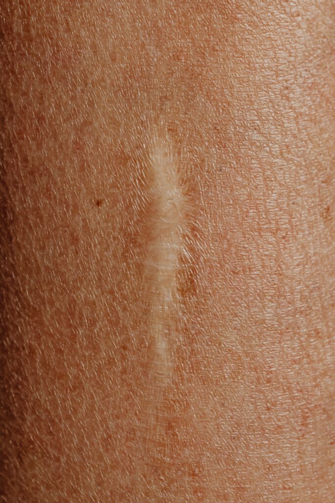 Dermatofuncional Detailed close-up image of a skin scar, highlighting texture and healing.