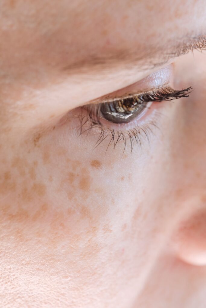 Dermatofuncional Closeup of crop female with freckles and blue eyes pensively looking away in daylight